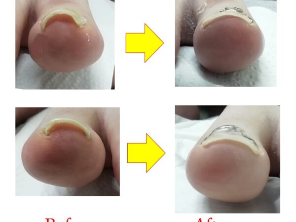 すぐ割れてトラブルになる爪も少しずつ健康な爪に変化してきました