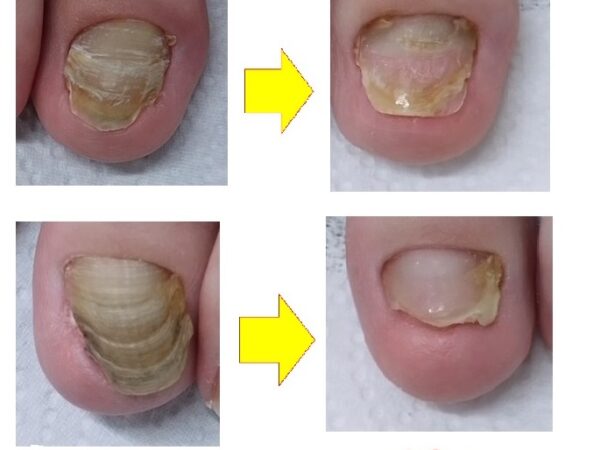 分厚くどうしようもなかった爪がキレイになりました