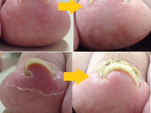 立っているだけでも痛かった巻き爪に悩んでいました