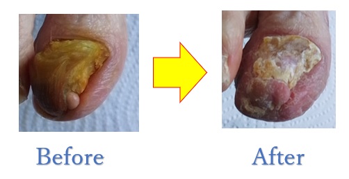 どんどん上に重なって靴も履けなかった爪が、元通りに復活しました。