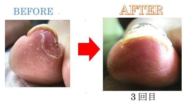 深爪からの痛み。初回で解放されました！