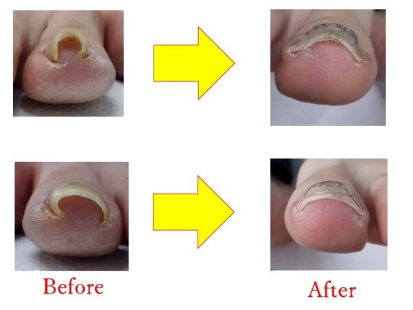 学生のころからの悩んでいた爪が改善しました！