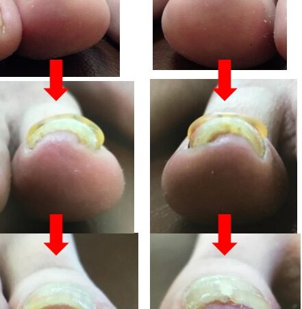 渦巻き状のひどい巻き爪でしたが今では見違えるようにきれいになりました！