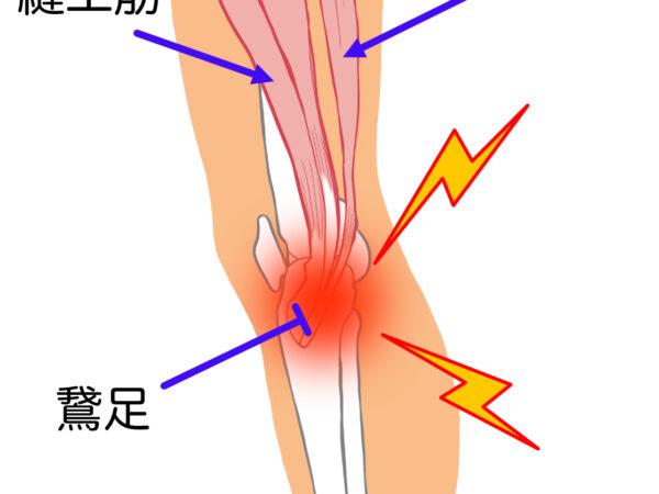 膝の内側のズキズキは年のせいじゃないかも？知られざる原因とは